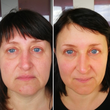 Zone Face Lift 12 weeks transformation